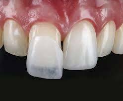 فرق بین لمینت و کامپوزیت دندان چیست؟